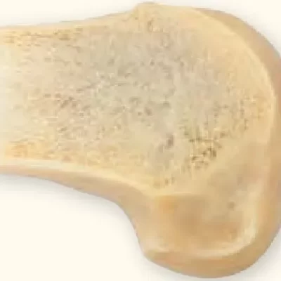 Condilo Femoral